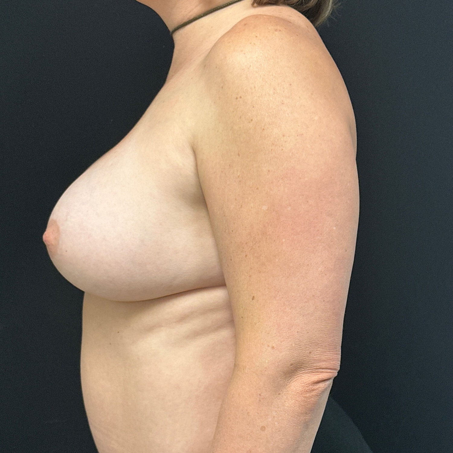 Breast Augmentation Before & After