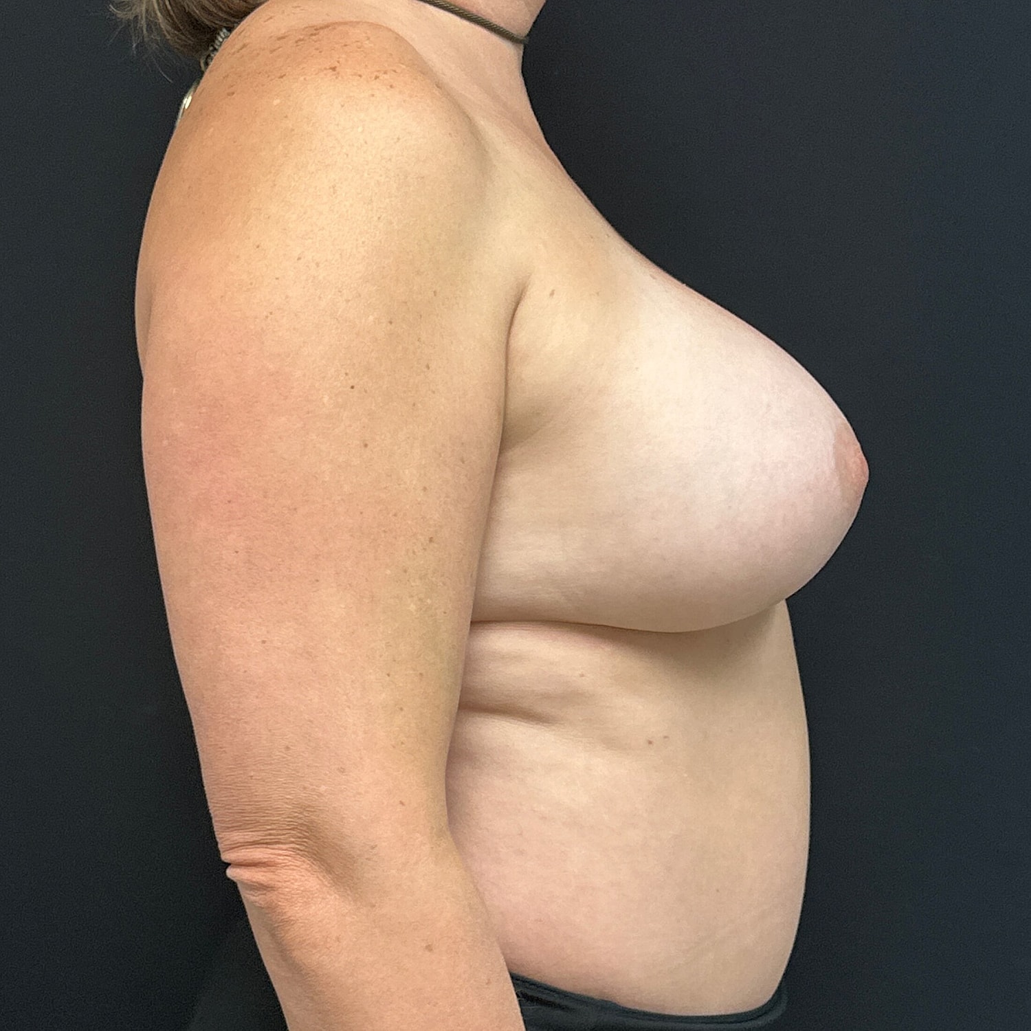 Breast Augmentation Before & After