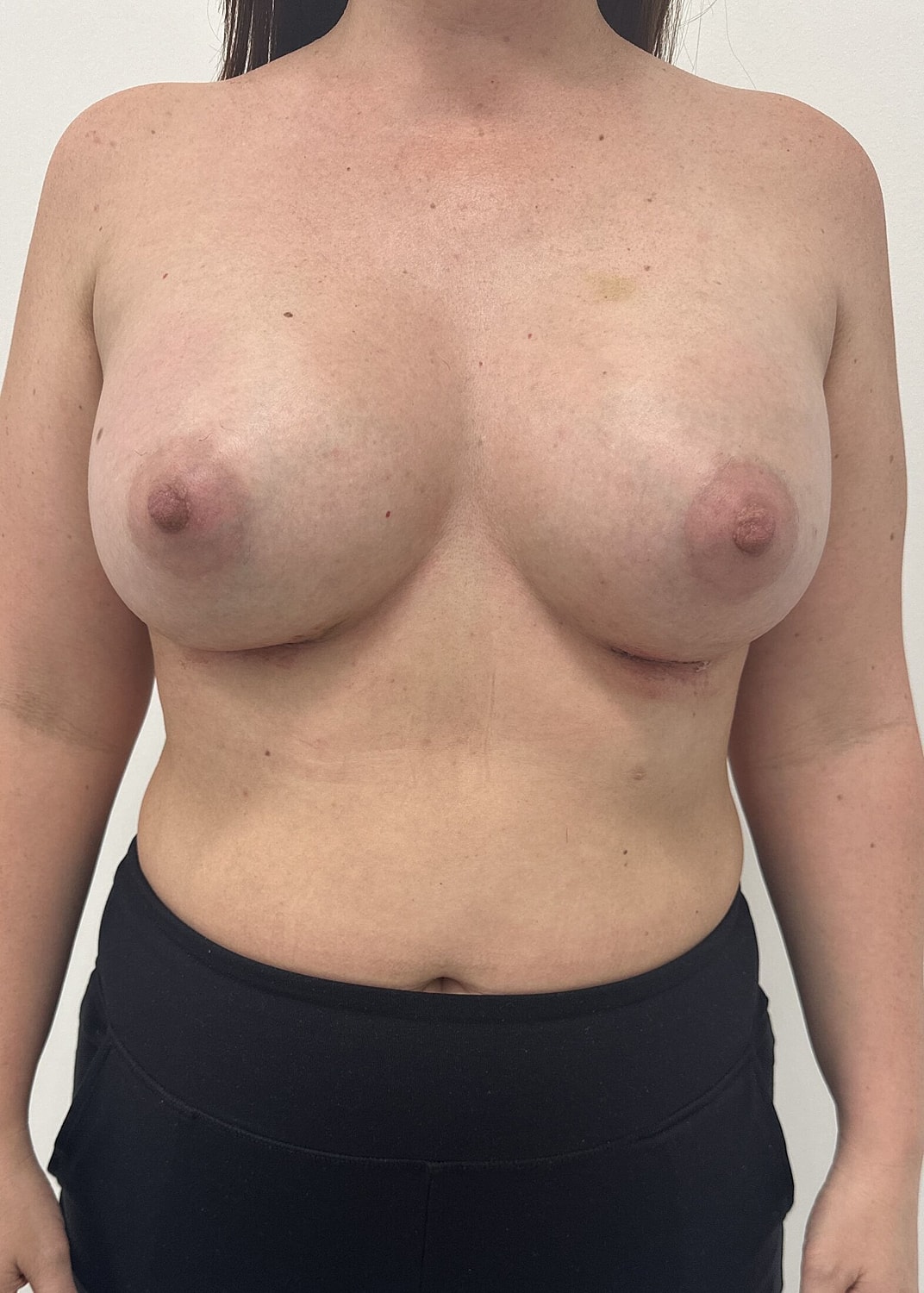 Breast Augmentation Before & After