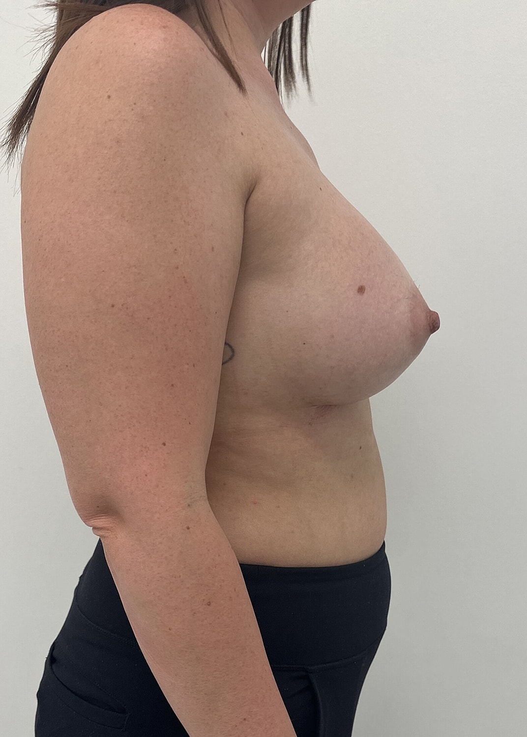 Breast Augmentation Before & After