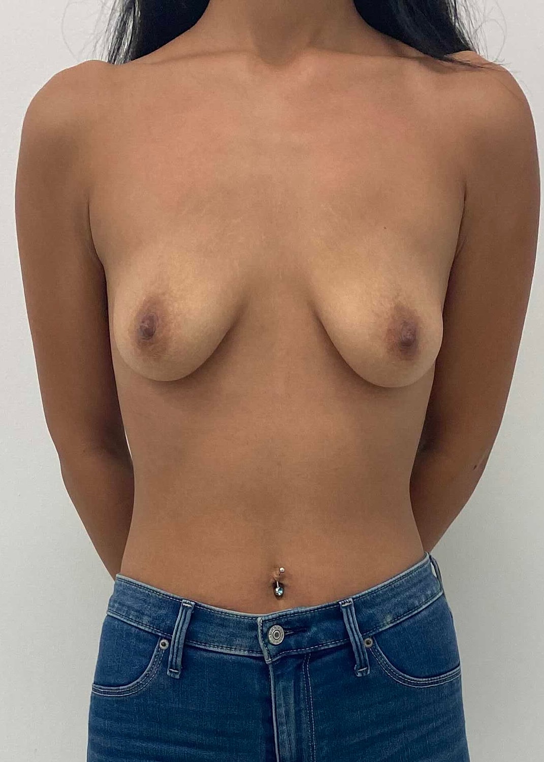 Breast Augmentation Before & After