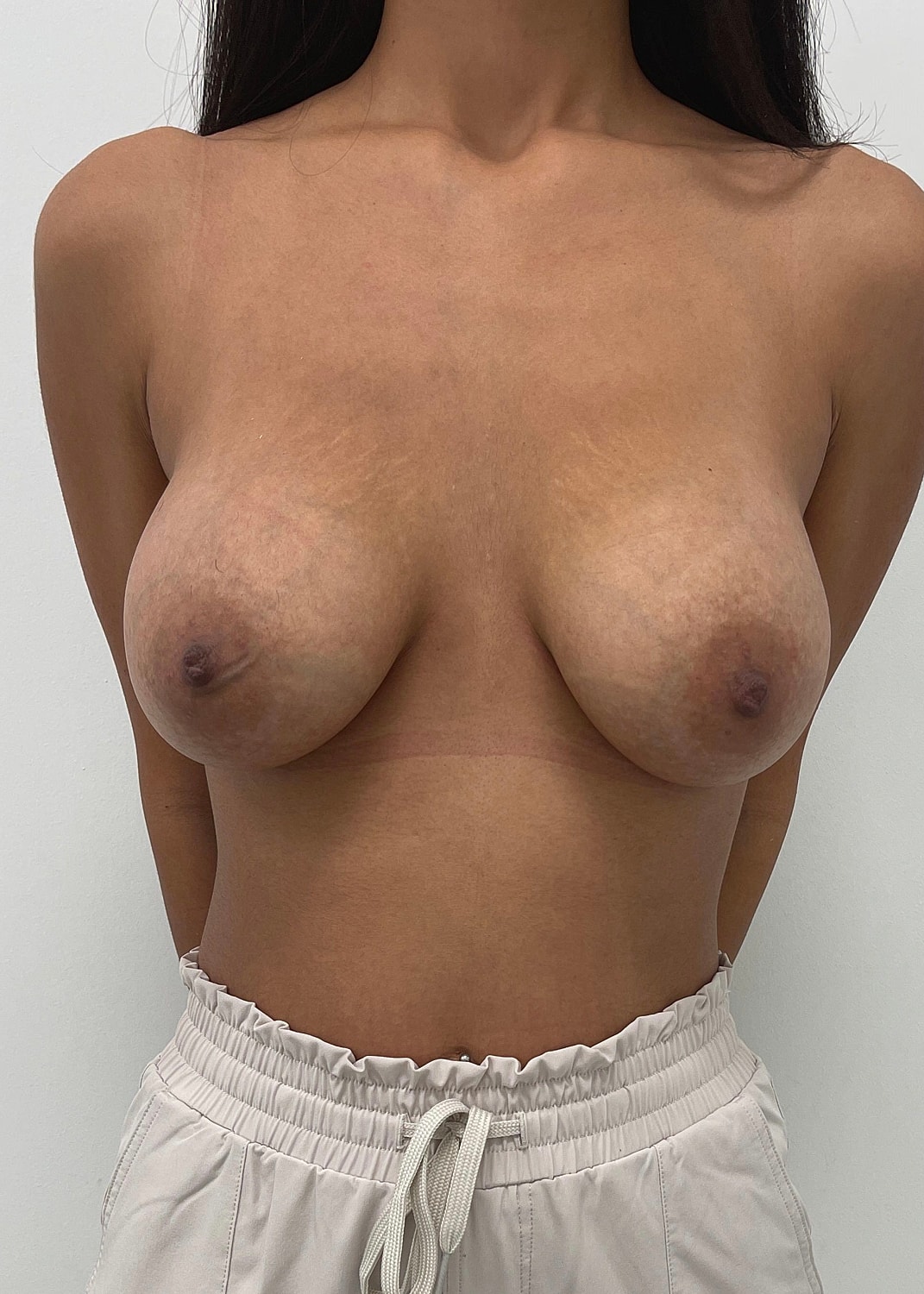 Breast Augmentation Before & After