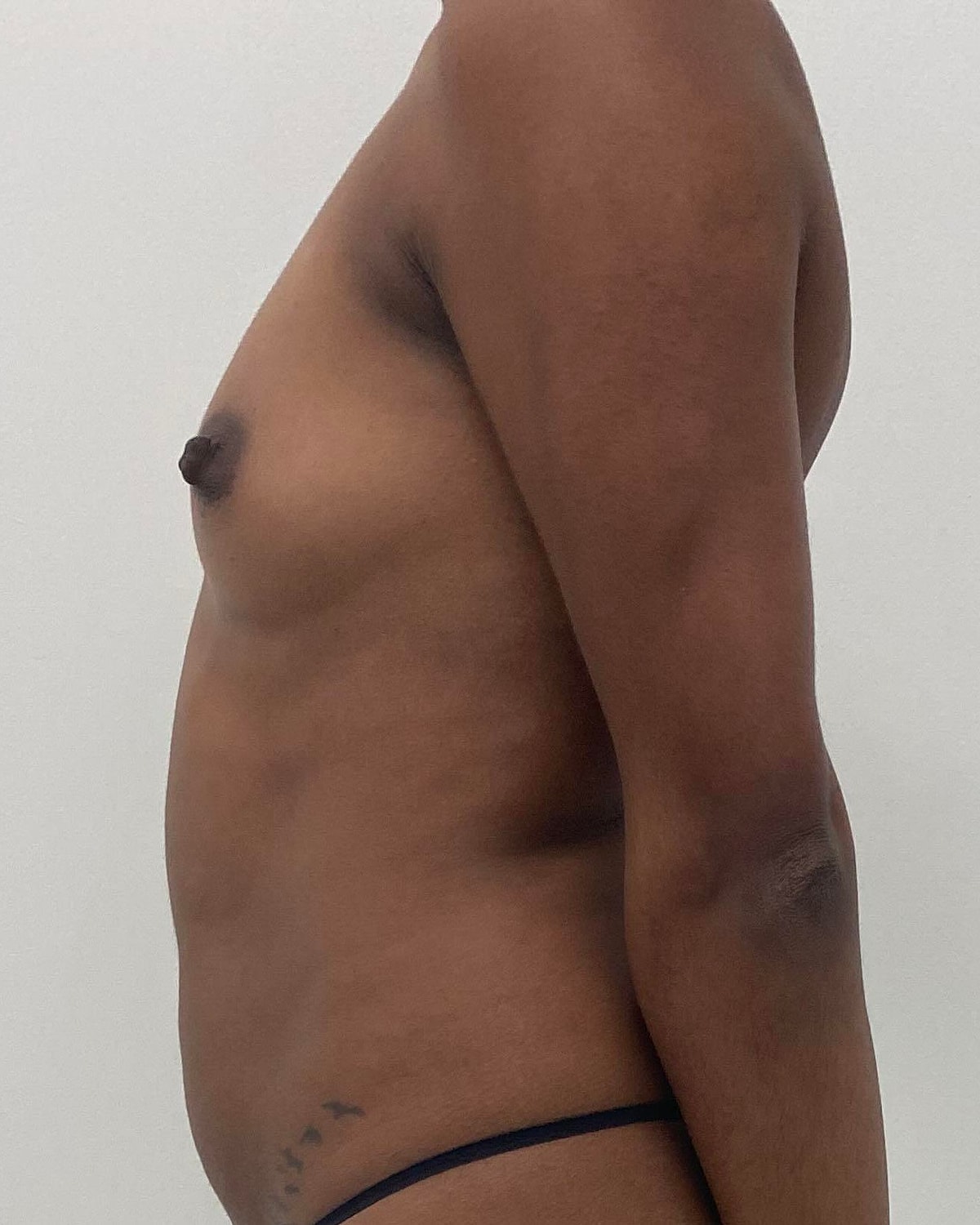 Breast Augmentation Before & After