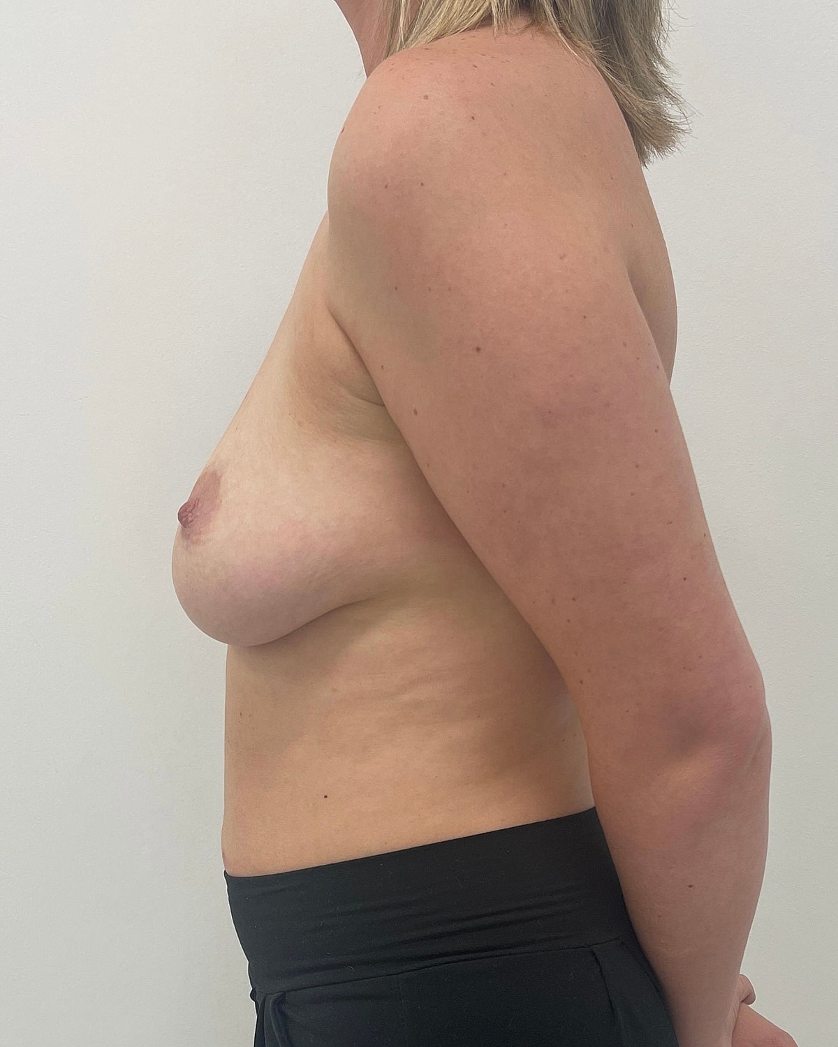 Breast Augmentation Before & After