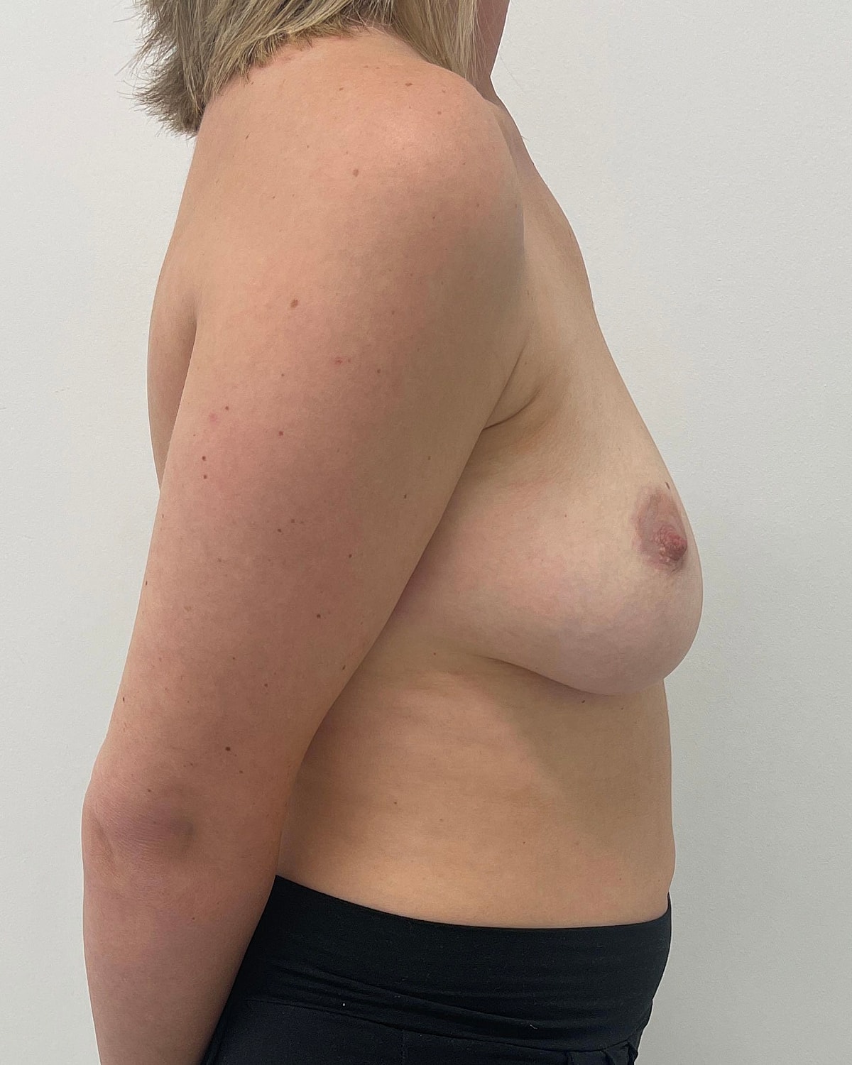 Breast Augmentation Before & After