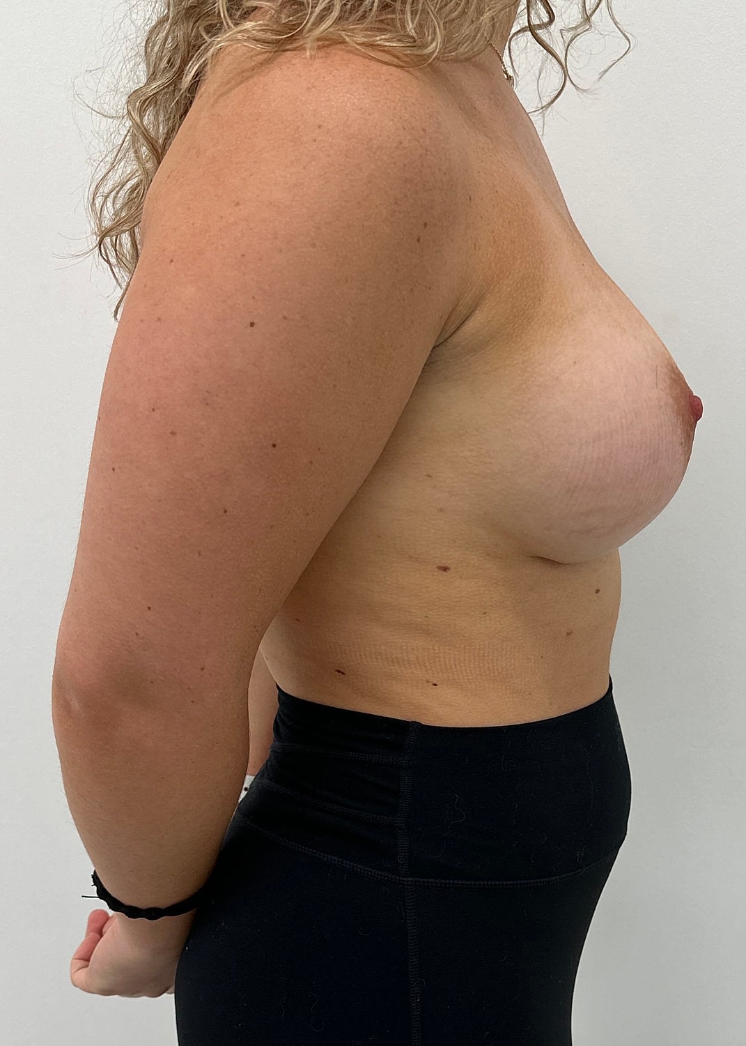 Breast Augmentation Before & After
