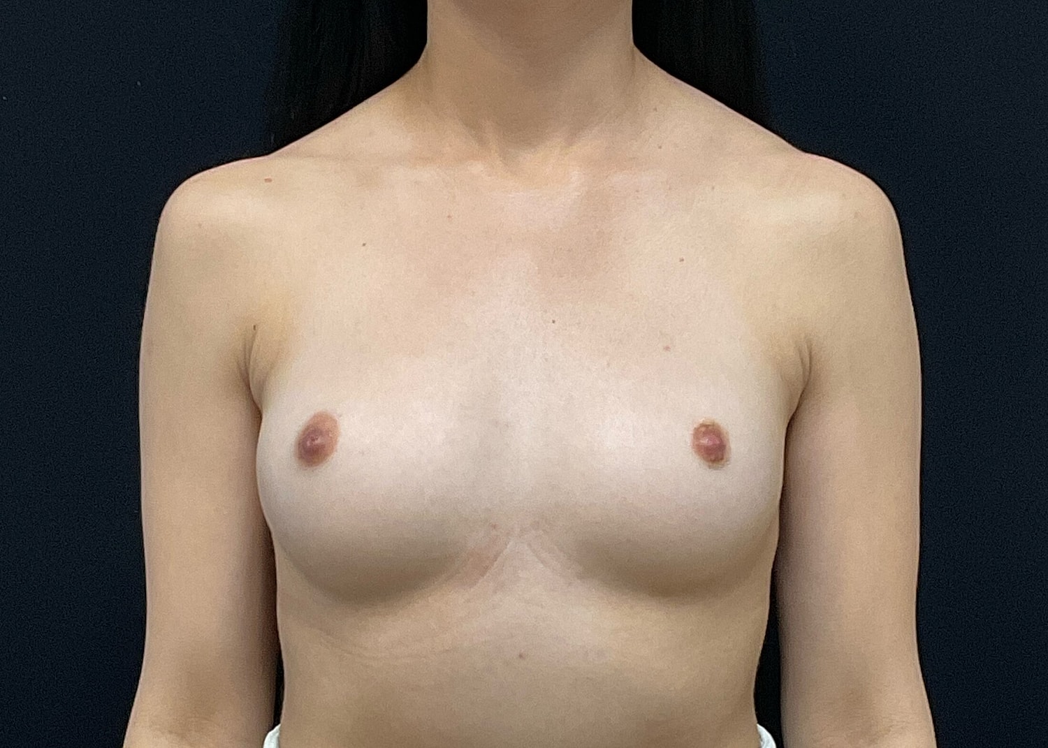 Breast Augmentation Before & After