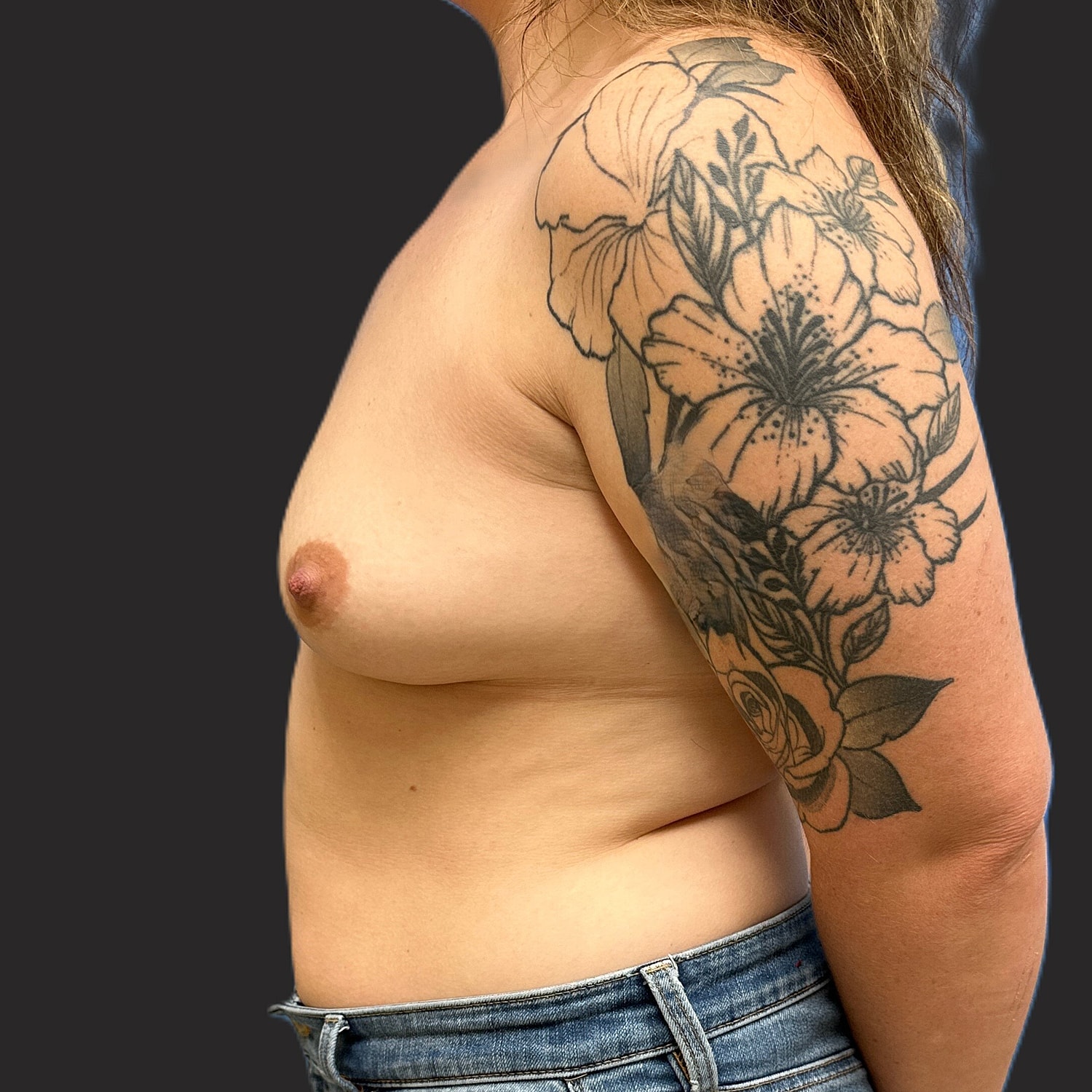 Breast Augmentation Before & After