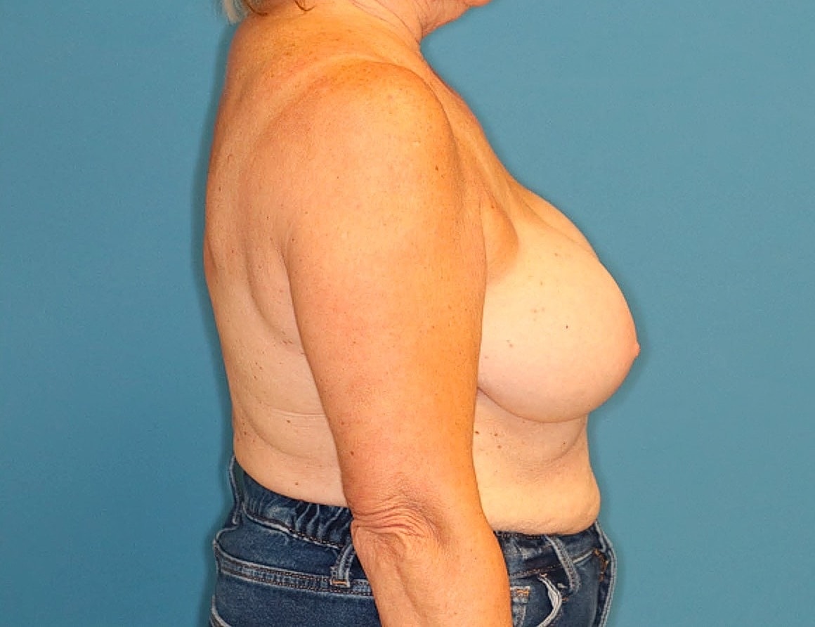 Breast Augmentation Before & After