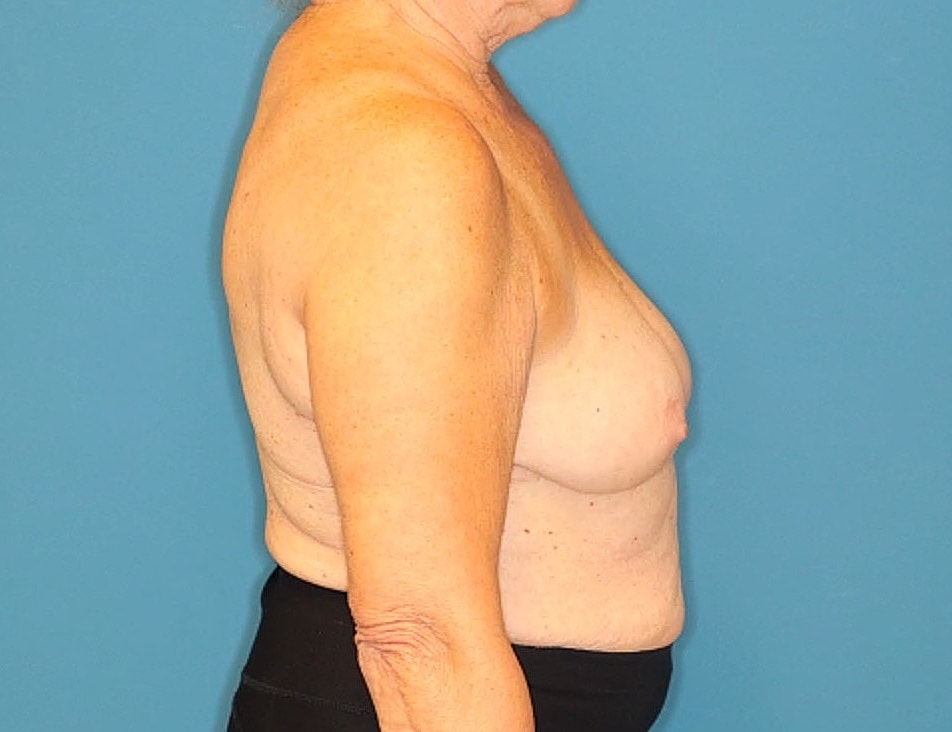 Breast Augmentation Before & After