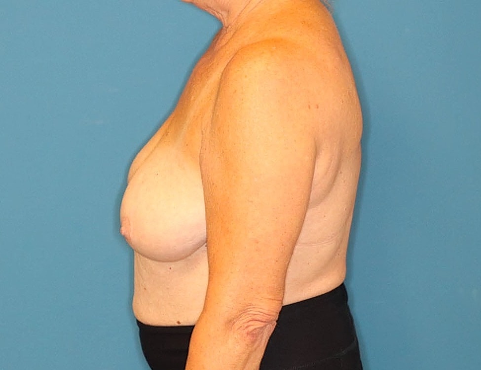 Breast Augmentation Before & After