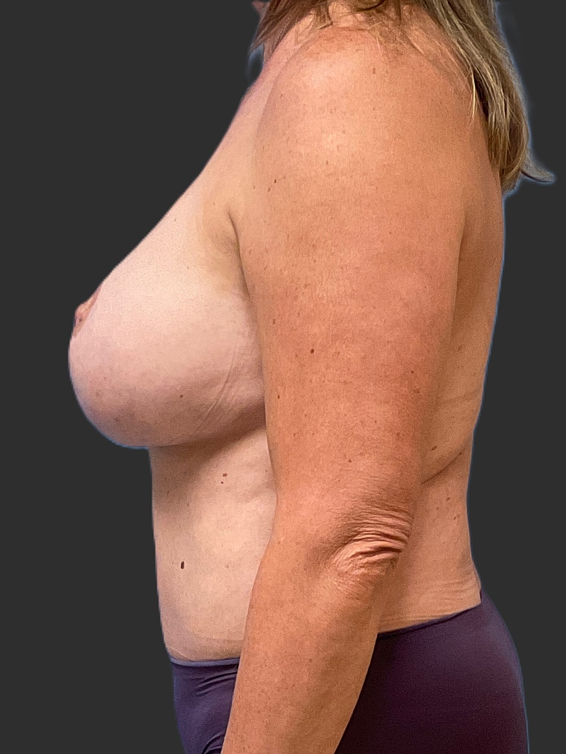 Breast Reduction Revision Before & After