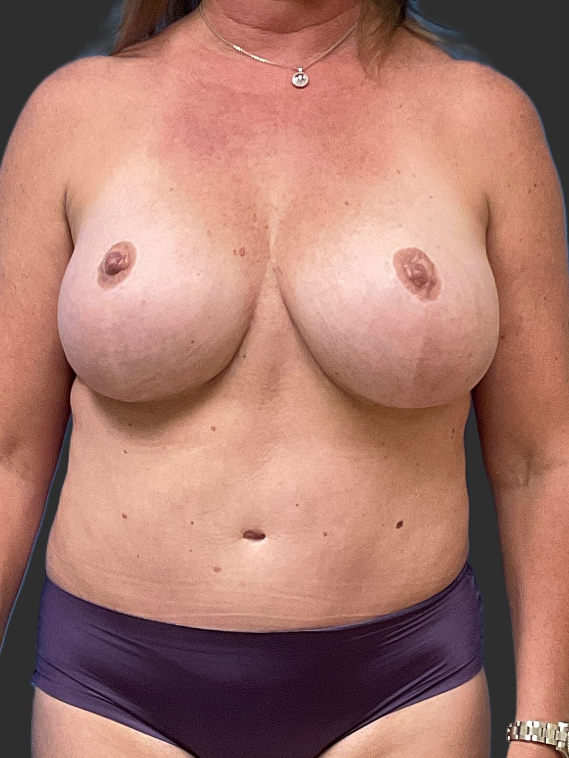 Breast Reduction Revision Before & After