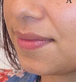 Facial Fillers Before & After