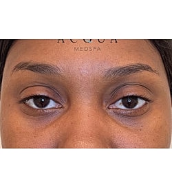 Facial Fillers Before & After