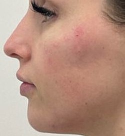 Facial Fillers Before & After