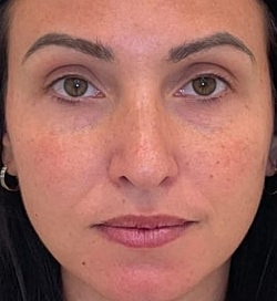 Facial Fillers Before & After