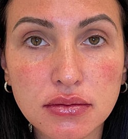 Facial Fillers Before & After