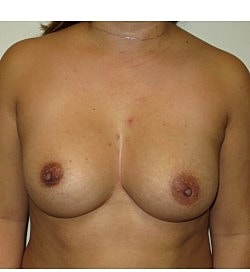 Breast Augmentation Revision Before & After