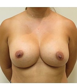 Breast Augmentation Revision Before & After