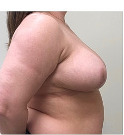 Breast Reduction Before & After