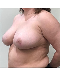 Breast Reduction Before & After