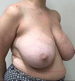 Breast Reduction Before & After
