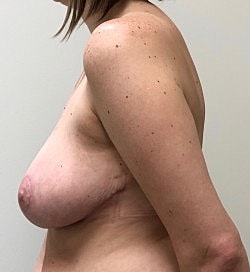 Breast Reduction Before & After