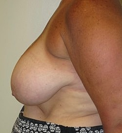 Breast Reduction Before & After