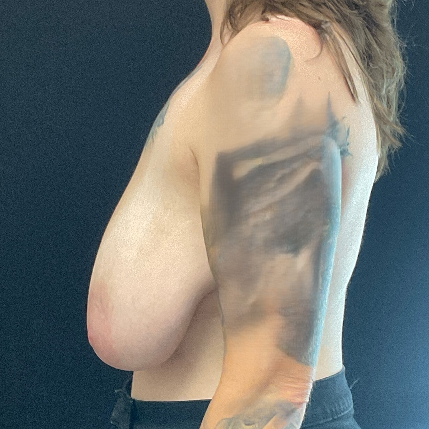 Breast Reduction Before & After