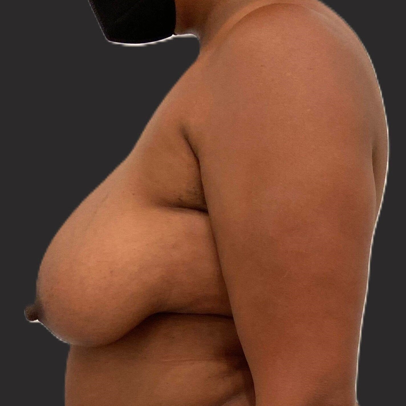 Breast Reduction Before & After