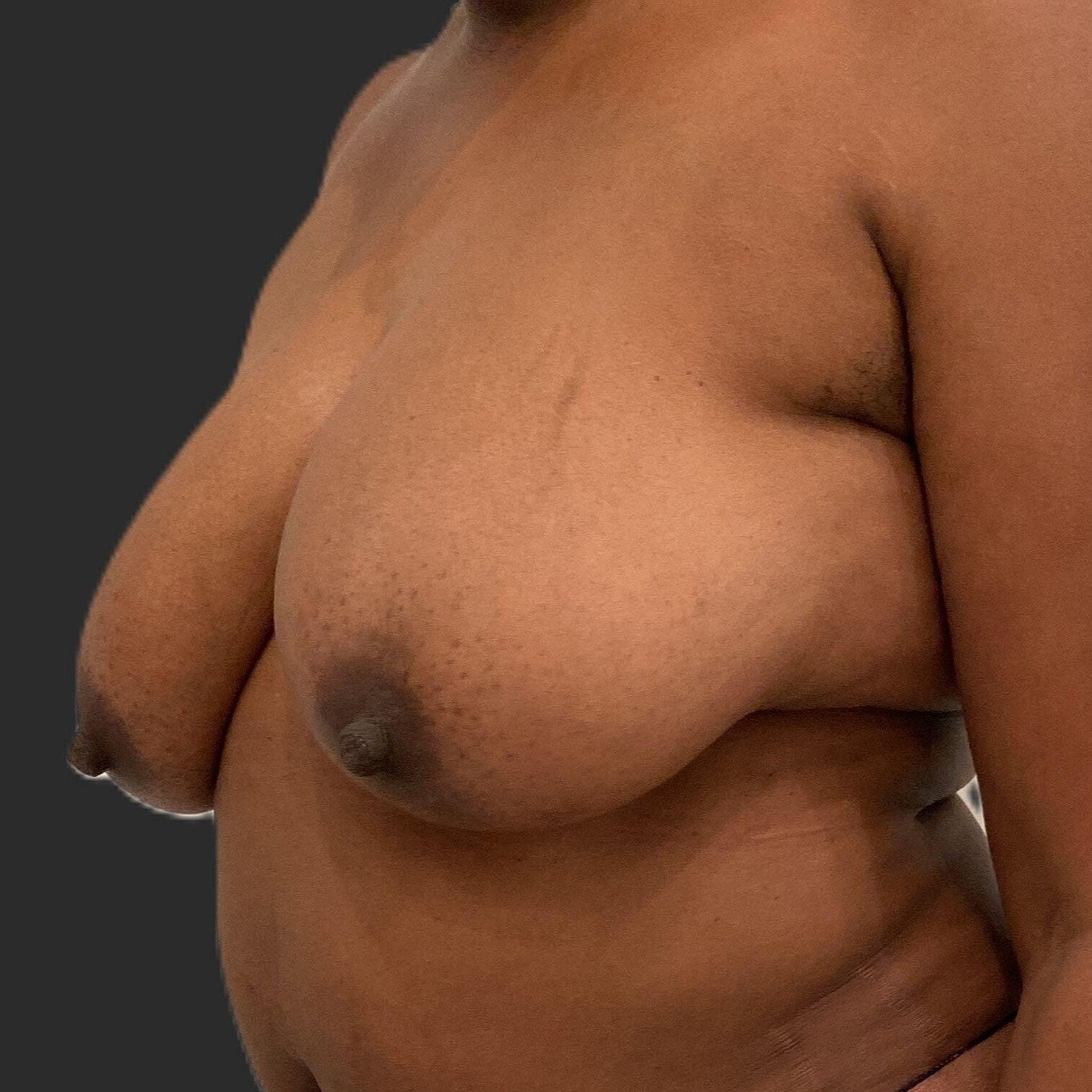Breast Reduction Before & After