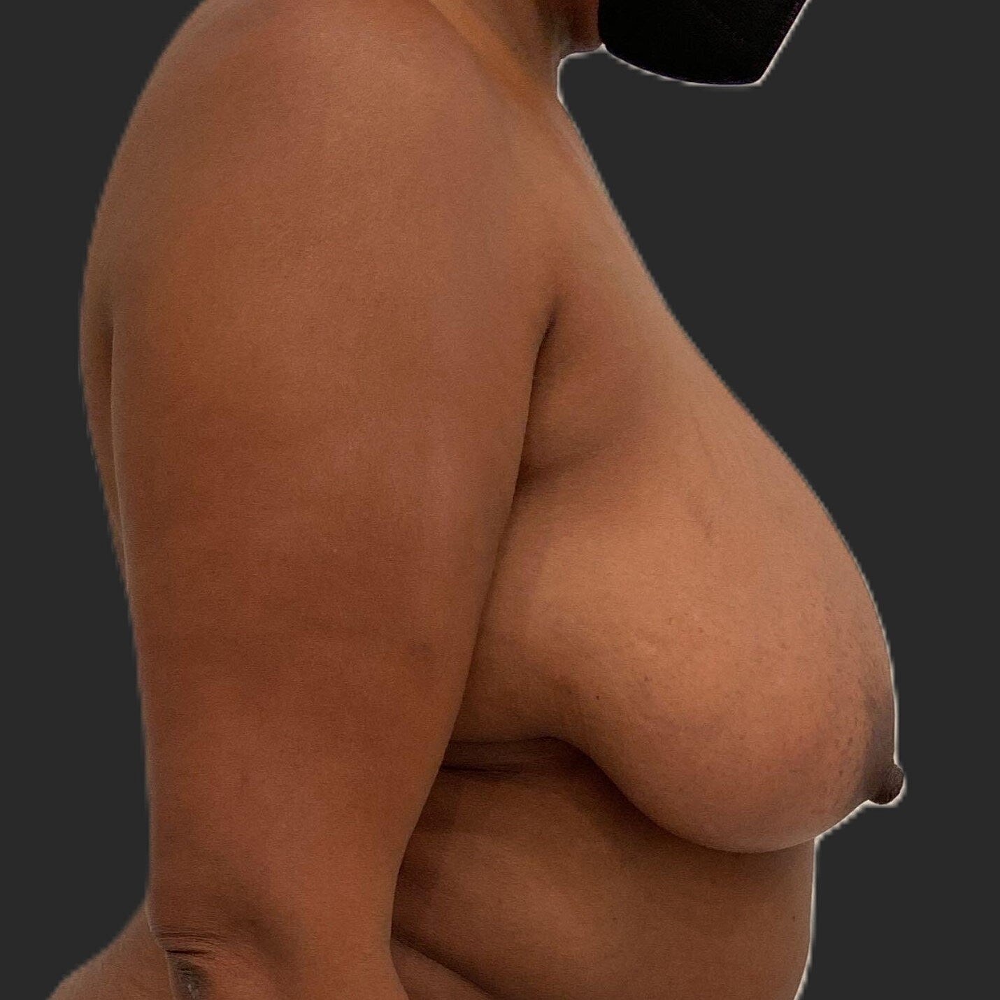 Breast Reduction Before & After