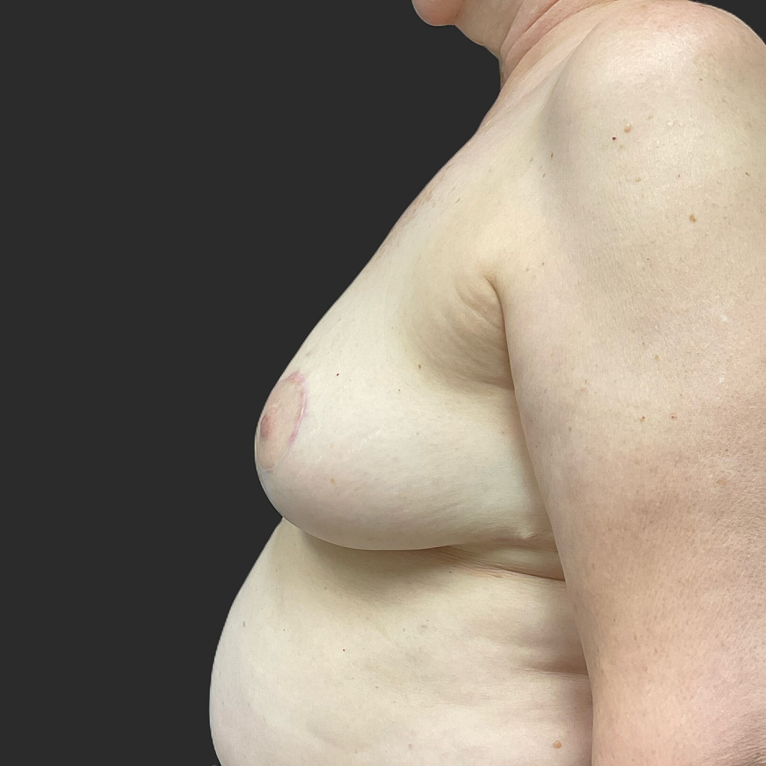 Breast Reduction Before & After