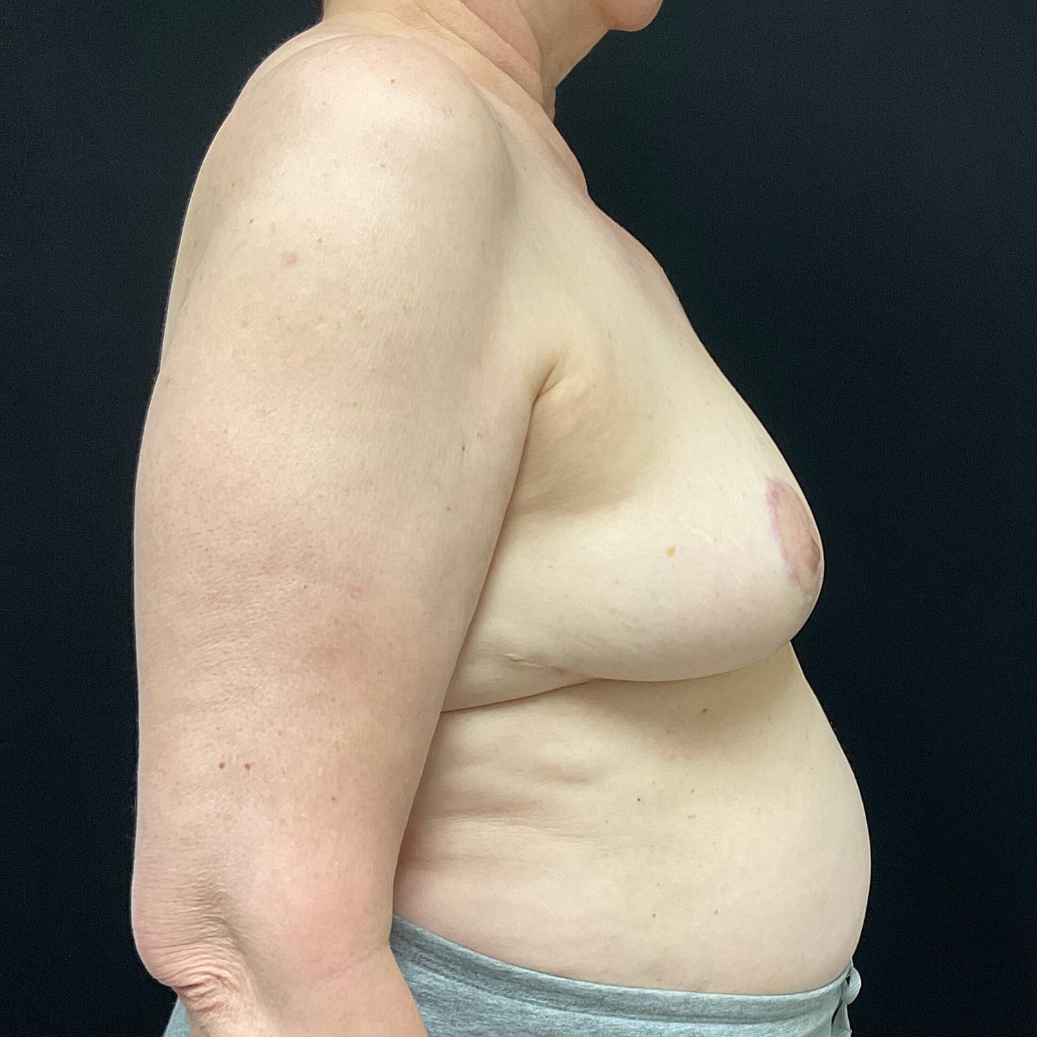 Breast Reduction Before & After