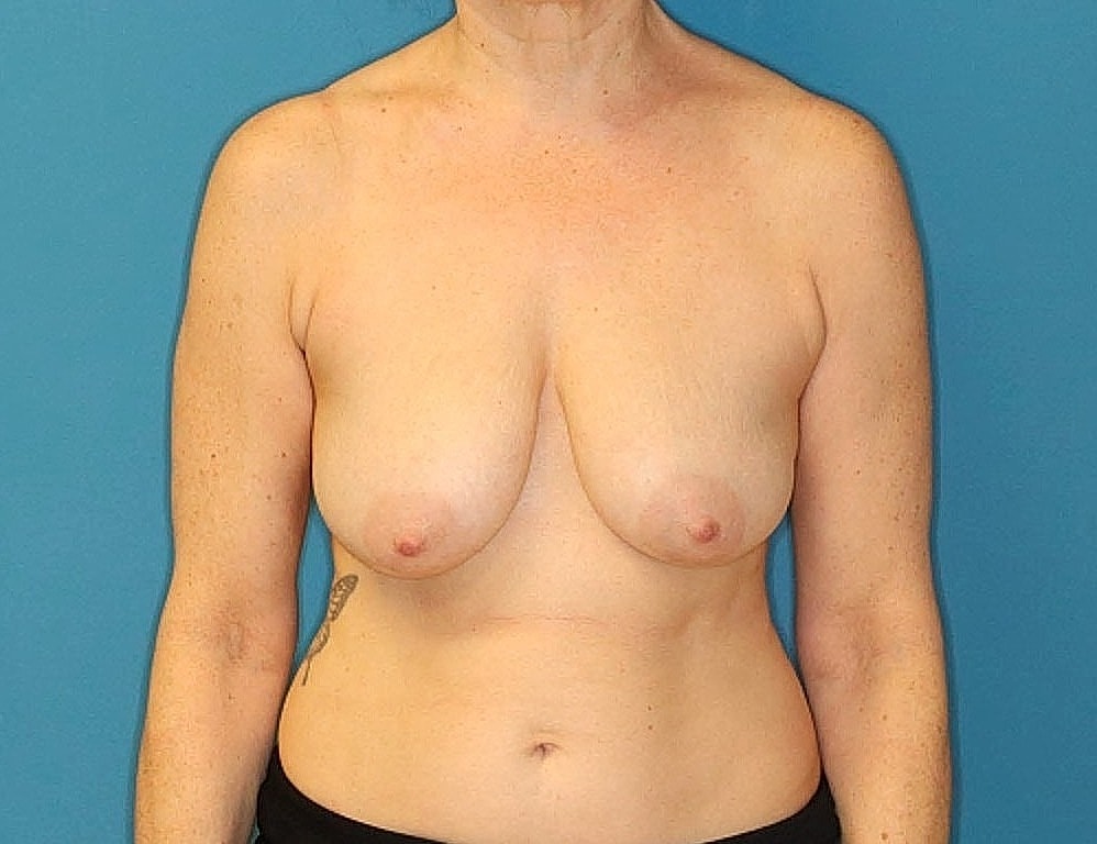 Breast Reduction Before & After