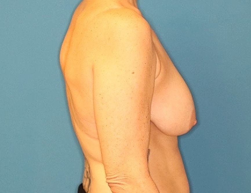Breast Reduction Before & After