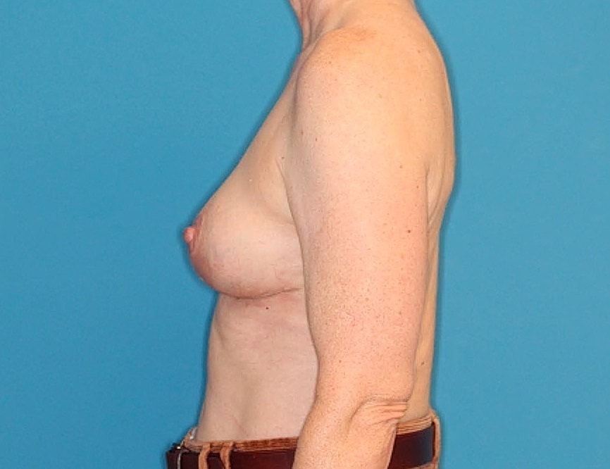 Breast Reduction Before & After