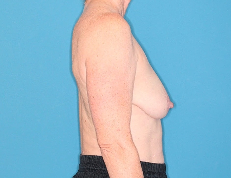 Breast Reduction Before & After