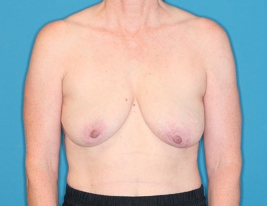 Breast Reduction Before & After