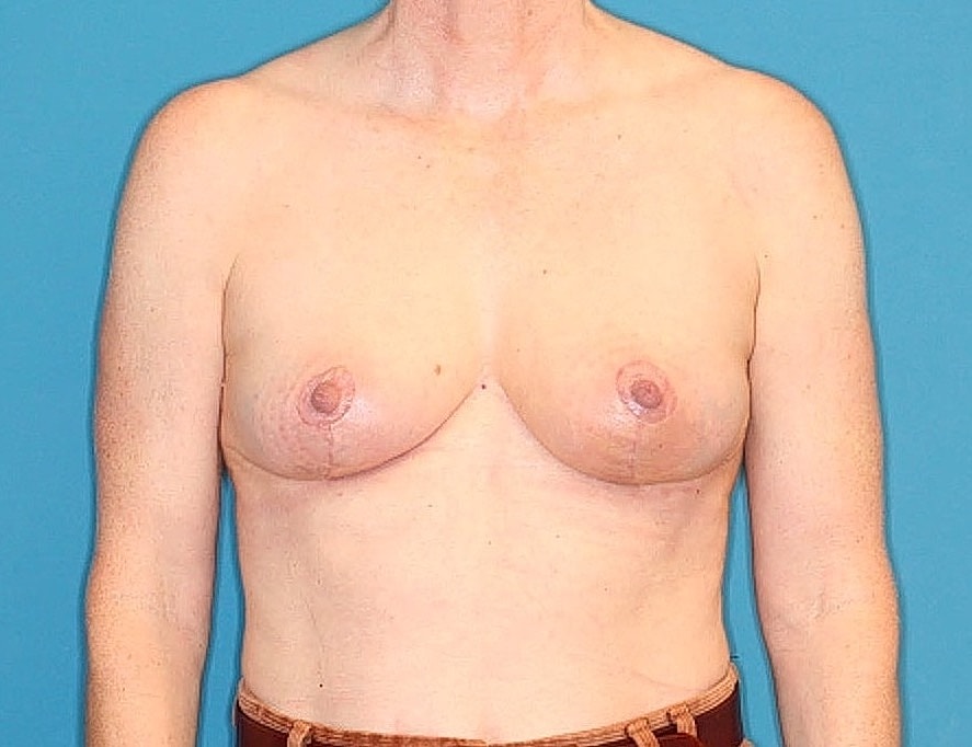 Breast Reduction Before & After