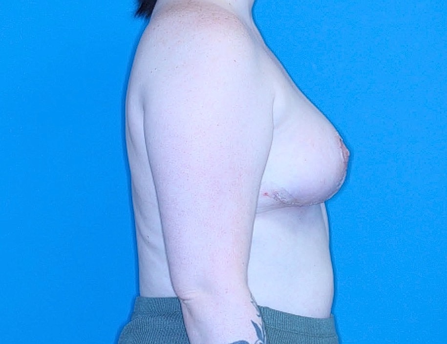 Breast Reduction Before & After