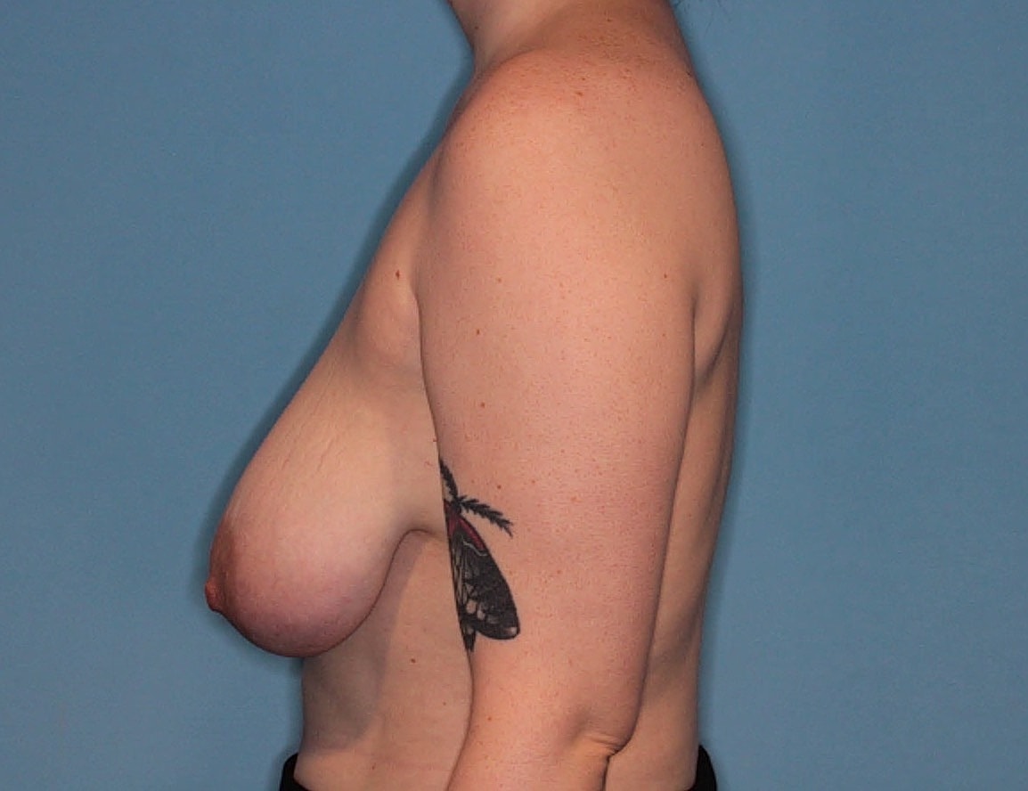 Breast Reduction Before & After