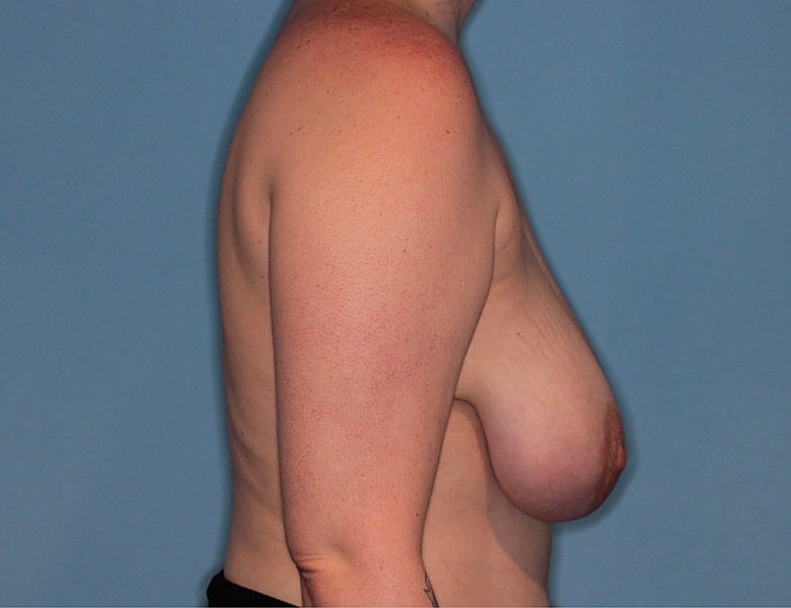 Breast Reduction Before & After