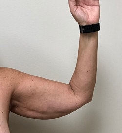 Arm Lift Before & After
