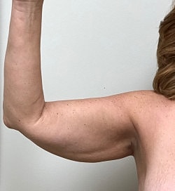 Arm Lift Before & After