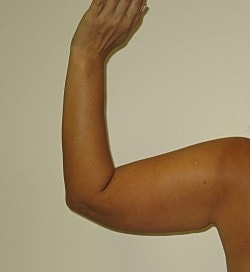 Arm Lift Before & After
