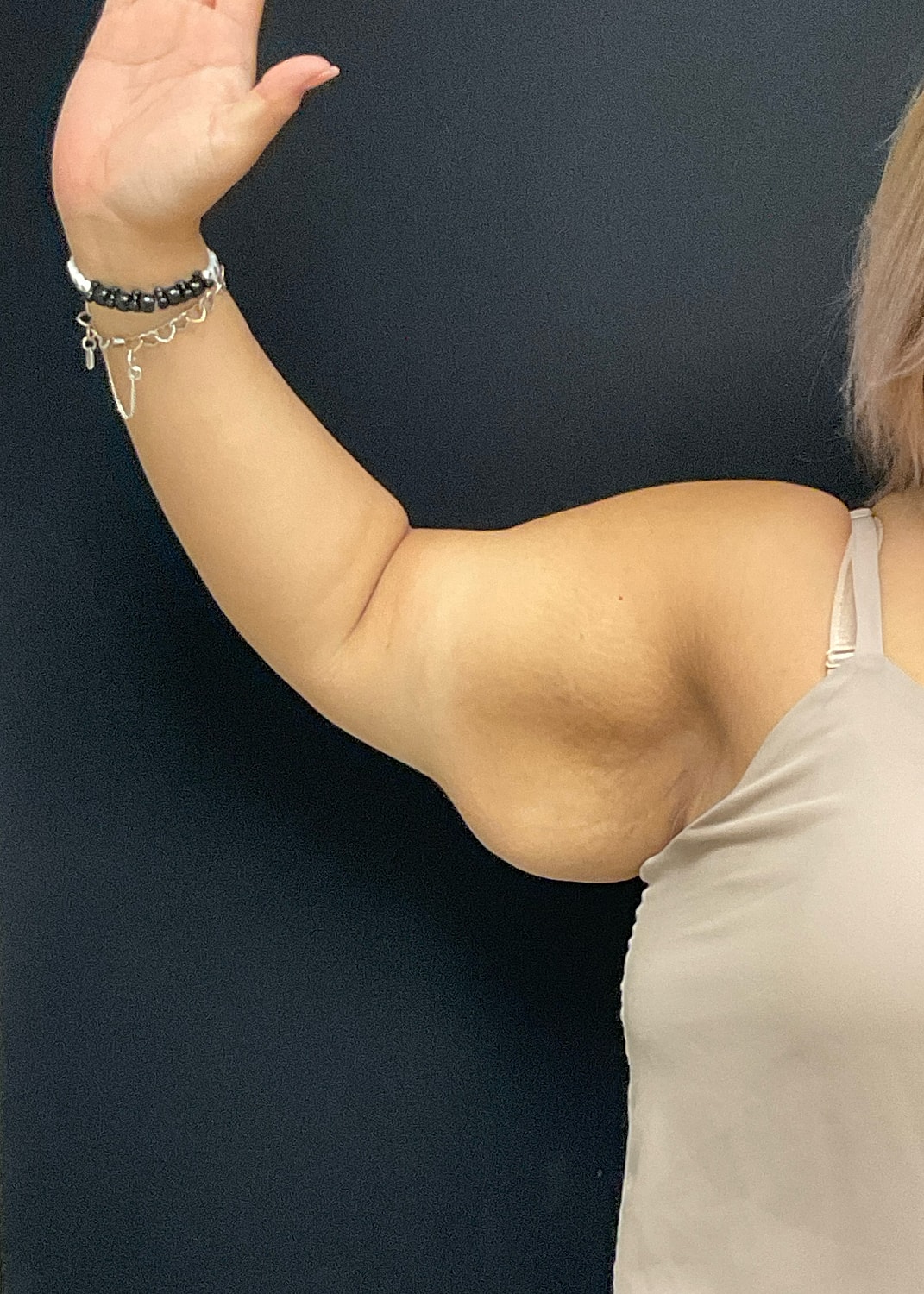 Arm Lift Before & After