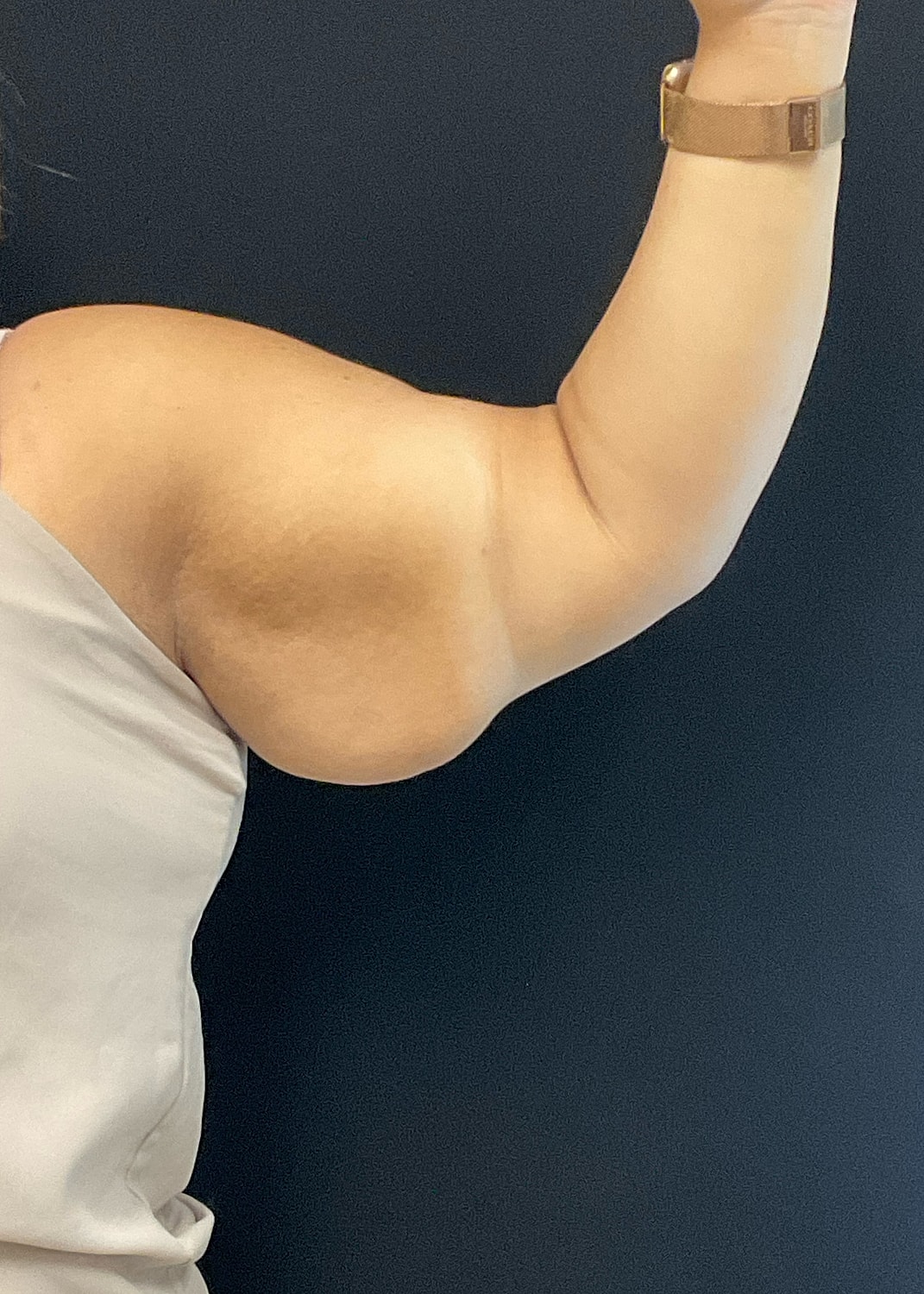 Arm Lift Before & After