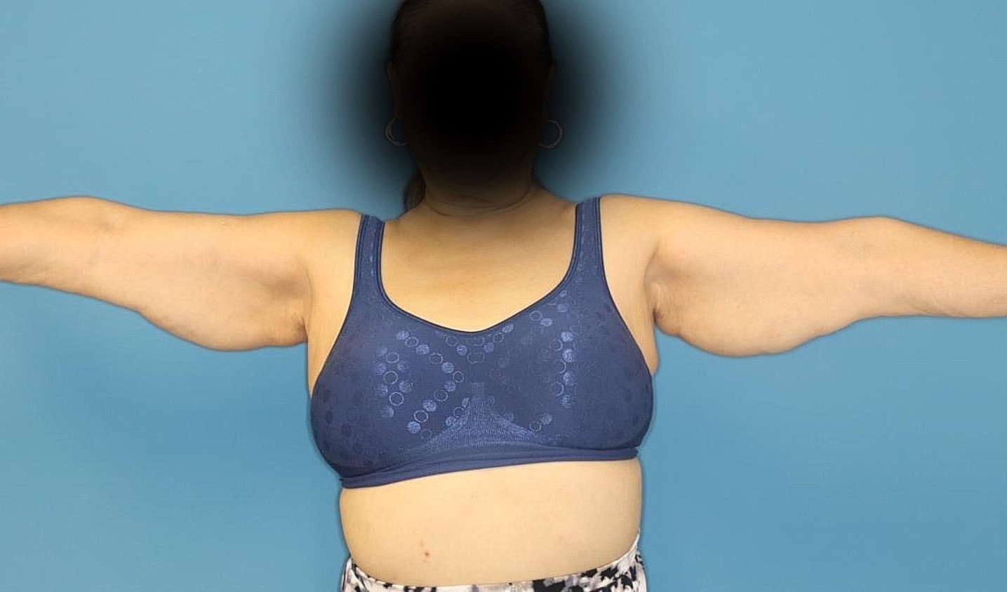 Arm Lift Before & After